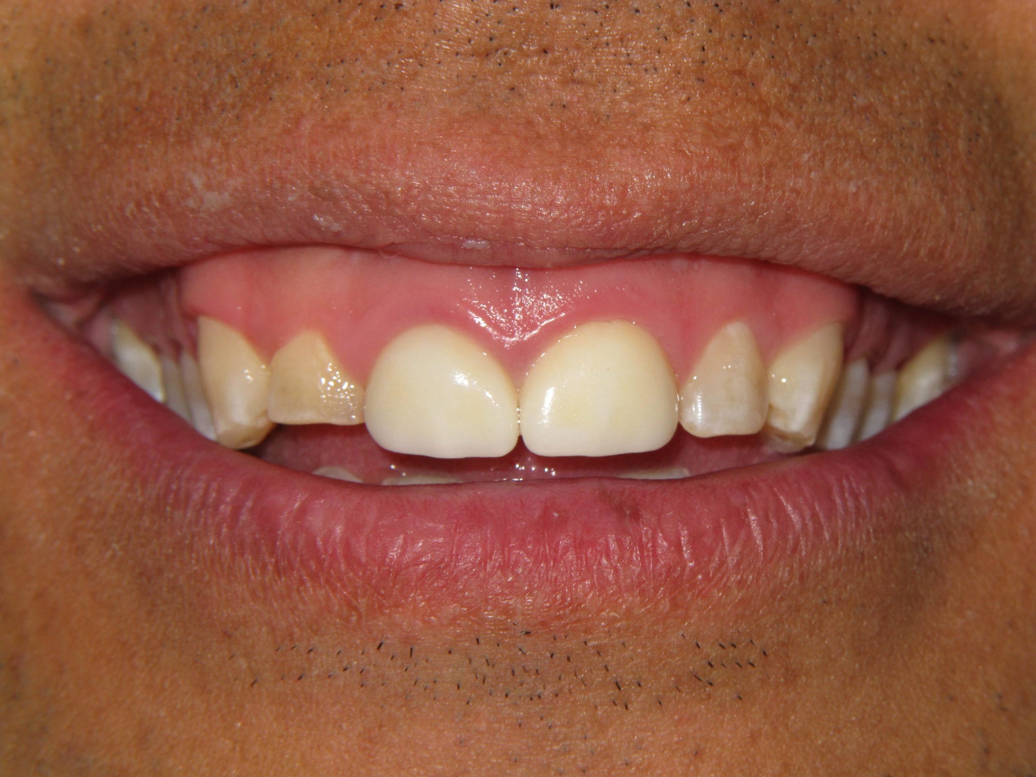 Closeup of Yellow Teeth
