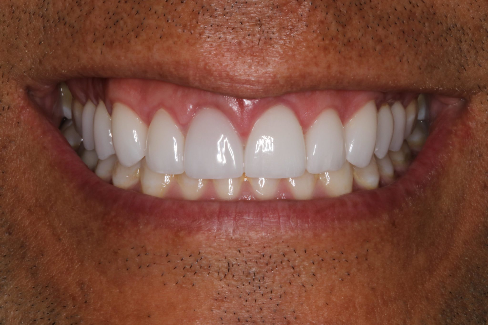 Closeup of WhiteTeeth