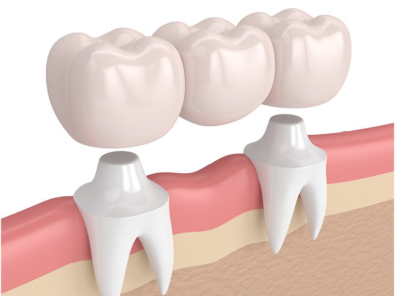 Image of Dental Bridge Being Applied