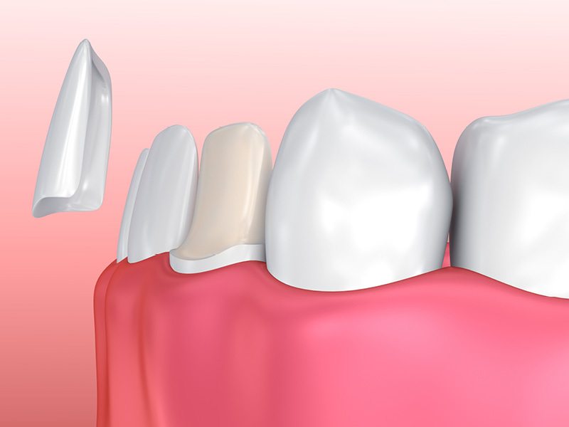 Image of Veneer Being Applied to Tooth