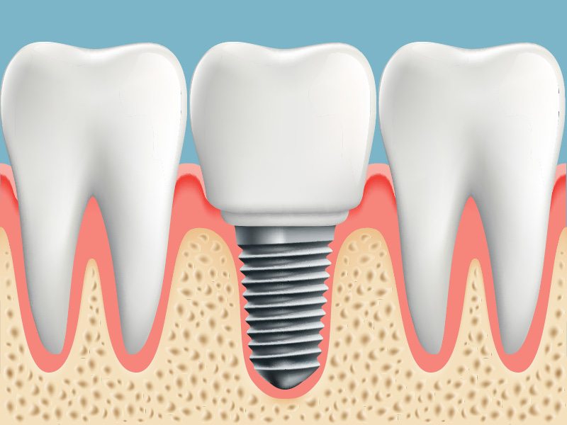 Dental Implant Inside Jaw