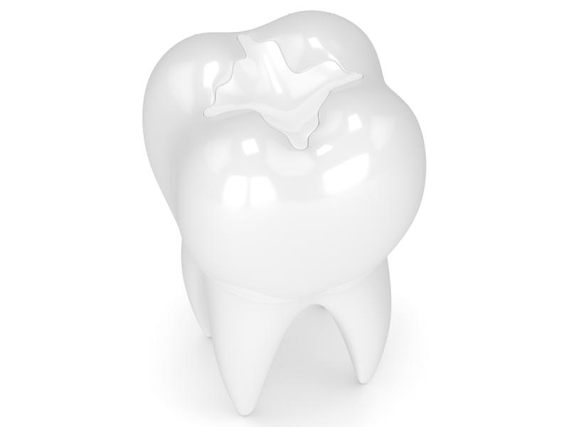 Image of a Filling on Top of a Tooth