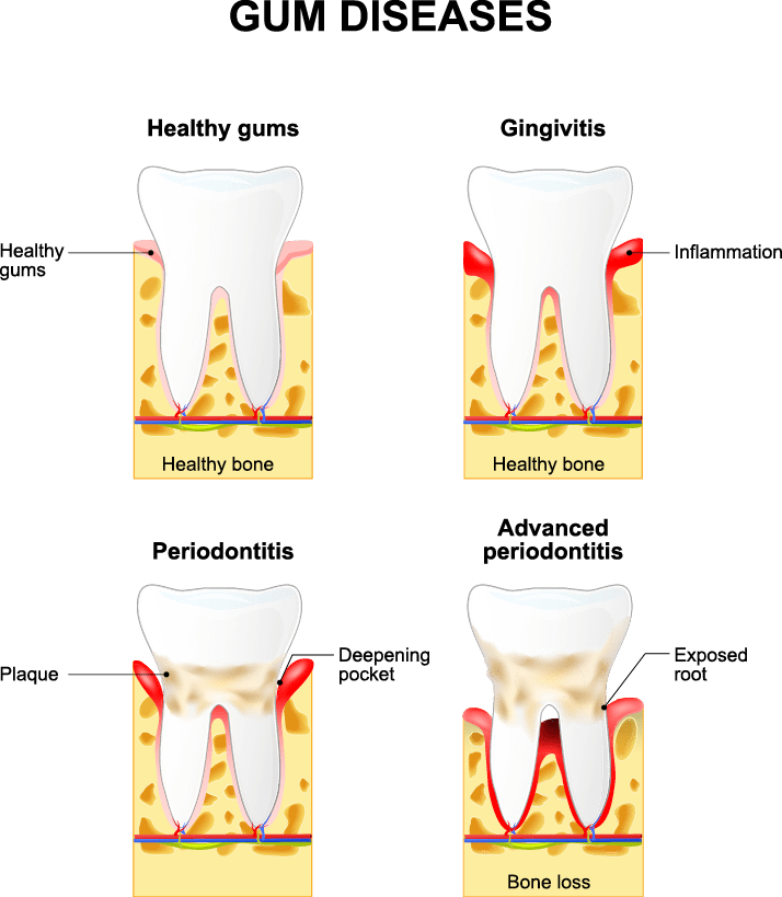 Gum Disease Chart