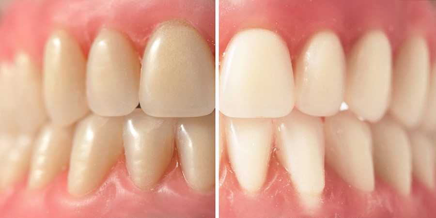 Before and After of Teeth Whitening
