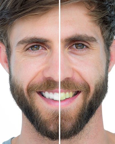 Before and After of Teeth Whitening