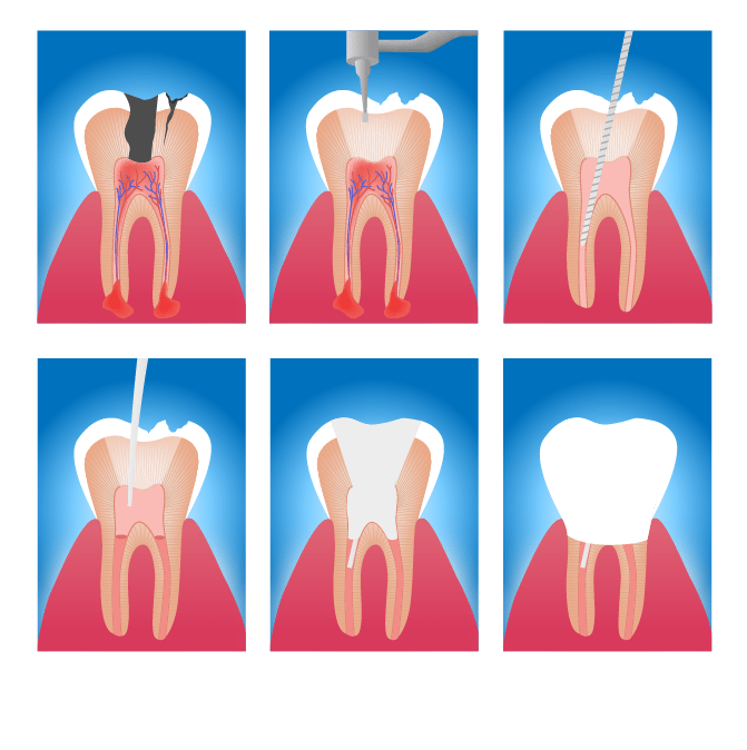 Example of How a Root Canal Works