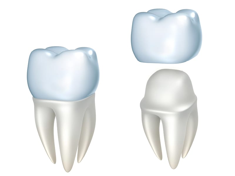 Example of How a Dental Crown is Applied