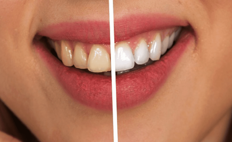 Before and After of Teeth Whitening