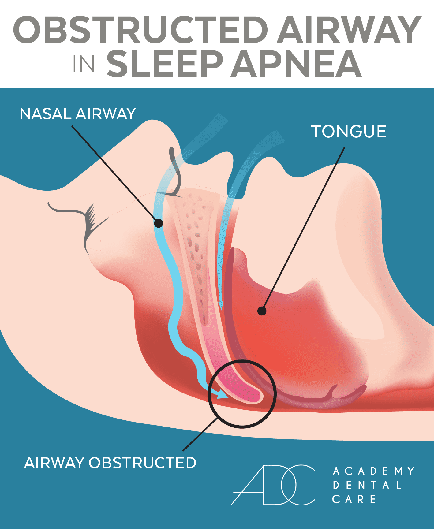 Example of Obstructed Airway in Sleep Apnea