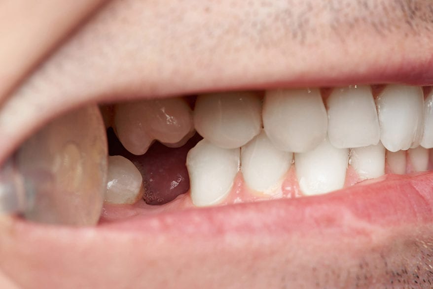 Closeup of Man with Missing Tooth